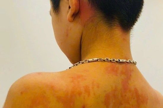 Trẻ 7 tuổi ở Hà Giang sốc phản vệ vì thói quen nhiều cha mẹ Việt hay làm mỗi khi bị ho