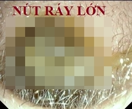 Cần làm gì khi trẻ kêu bị đau tai?- Lời khuyên của bác sĩ-4