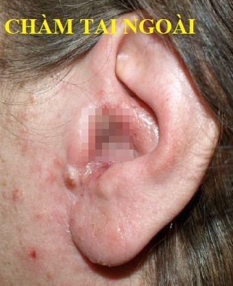 Cần làm gì khi trẻ kêu bị đau tai?- Lời khuyên của bác sĩ-5