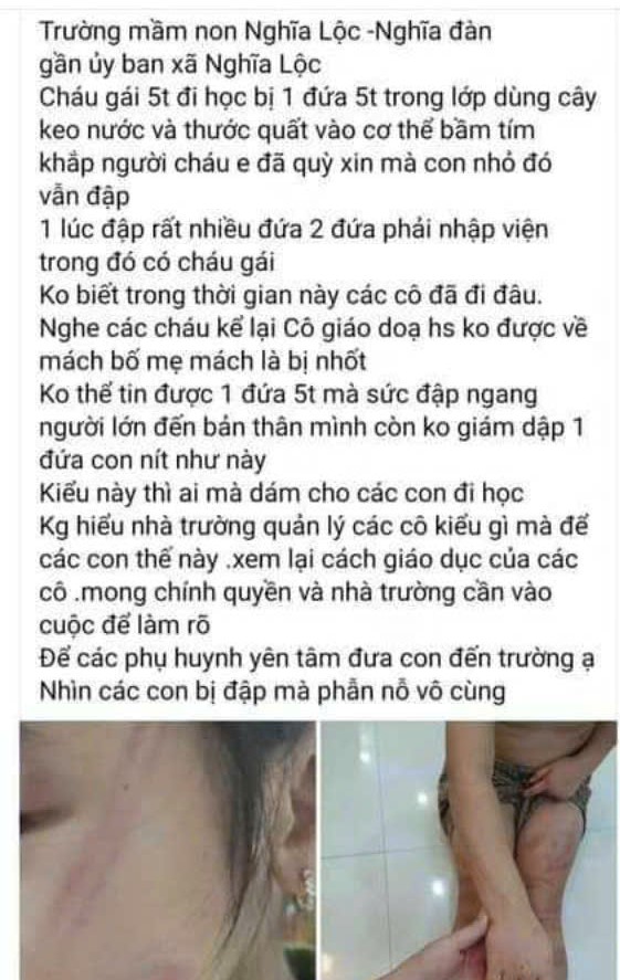 Nhiều trẻ mầm non bị bạn đánh bầm tím cơ thể tại lớp học-1