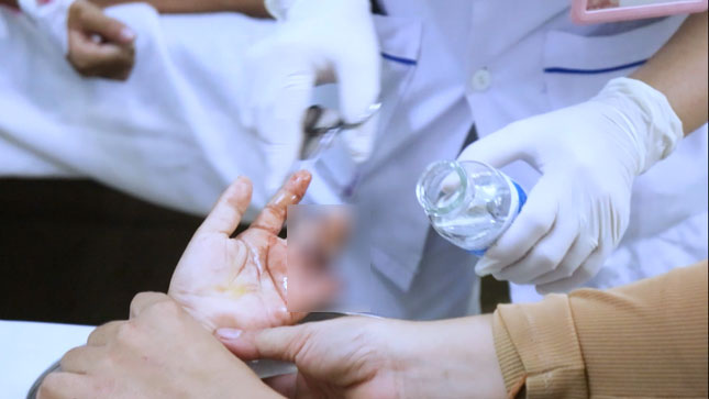 Bé trai đứt lìa 3 ngón tay vì tự dùng dao bổ mít-1