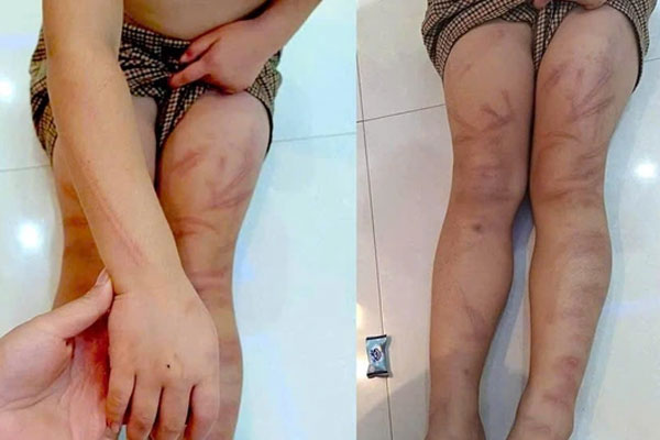 Vụ 6 trẻ mầm non ở Nghệ An bị đánh bầm tím: Một em vẫn phải điều trị ở bệnh viện-3