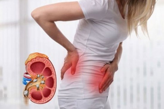 6 nguyên nhân gây sỏi thận nhiều người mắc phải