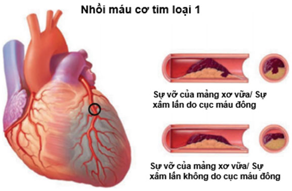 Người đàn ông đột tử lúc nửa đêm vì nhồi máu cơ tim đã bỏ qua dấu hiệu cảnh báo này-2