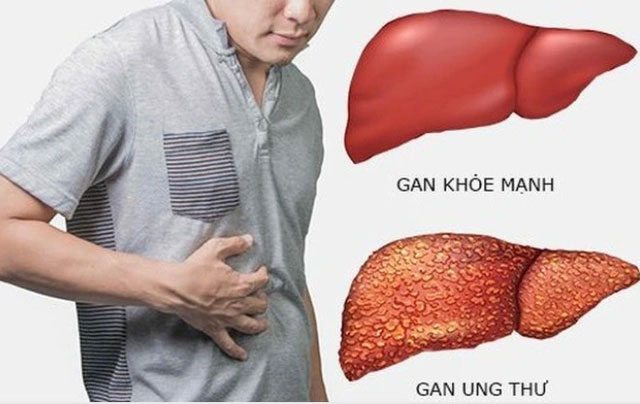 Gầy sút 5 kg trong 1 tháng, người đàn ông đi khám bất ngờ phát hiện ung thư gan-2