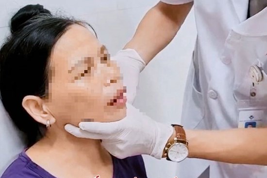 Người phụ nữ 56 tuổi ở Tuyên Quang trật khớp thái dương hàm chỉ vì... ngáp