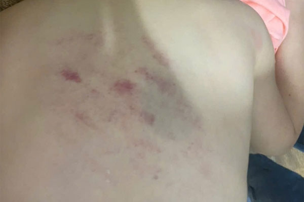 Điều chuyển công việc cô giáo ở Thanh Hóa bị tố gây bầm tím trên người học sinh lớp 1-2