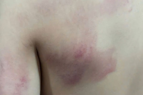 Đình chỉ công tác cô giáo tác động vật lý khiến học sinh lớp 1 thâm tím lưng-3