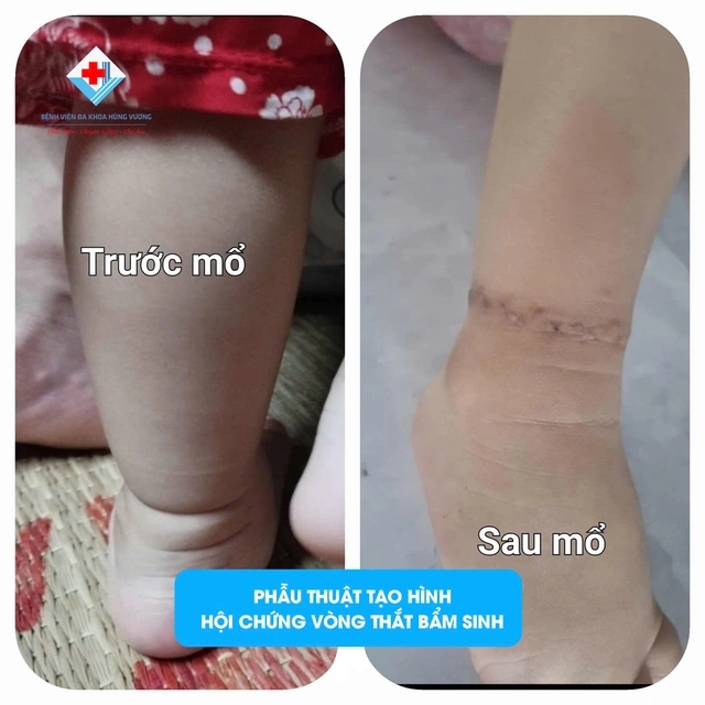 Có ngấn ở chân, bố mẹ ở Phú Thọ tưởng con bụ bẫm, nào ngờ đi khám phát hiện dị tật bẩm sinh-1