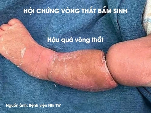 Có ngấn ở chân, bố mẹ ở Phú Thọ tưởng con bụ bẫm, nào ngờ đi khám phát hiện dị tật bẩm sinh-2