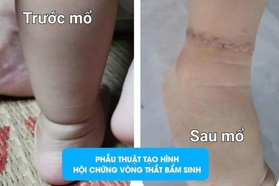 Có ngấn ở chân, bố mẹ ở Phú Thọ tưởng con bụ bẫm, nào ngờ đi khám phát hiện dị tật bẩm sinh
