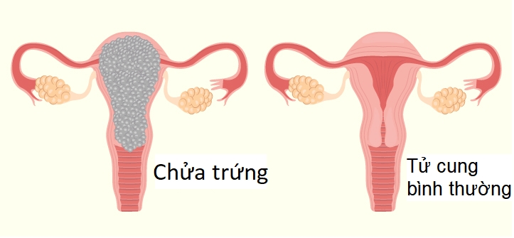 Chửa trứng có nguy hiểm không?-1