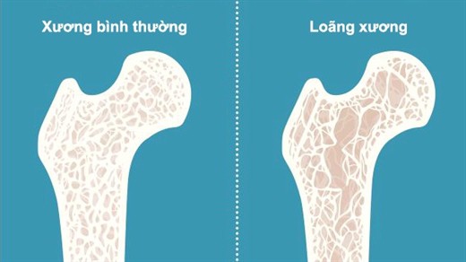 Bị đau lưng trên bên phải là bệnh gì? Có nguy hiểm không?-2