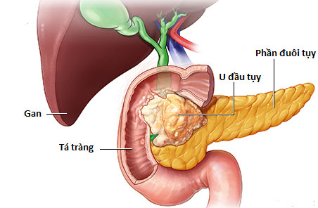 Người đàn ông 30 tuổi bất ngờ phát hiện ung thư tuyến tuỵ thừa nhận một sai lầm nhiều người Việt mắc phải-1