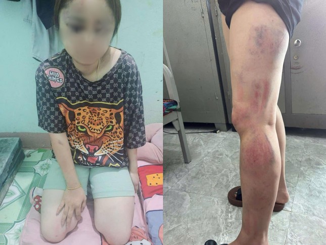 Bị bạn trai bạo hành 13 tiếng, cô gái nhắn tin cầu cứu bạn thân-1