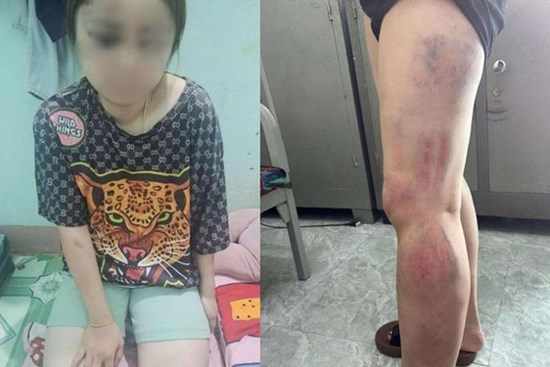 Bị bạn trai bạo hành 13 tiếng, cô gái nhắn tin cầu cứu bạn thân