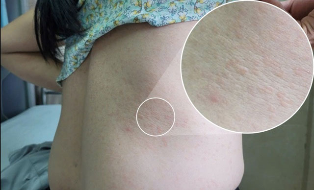 Sẩn ngứa khắp người, người phụ nữ 51 tuổi ở Phú Thọ đi khám bất ngờ dương tính với giun đũa chó mèo-1