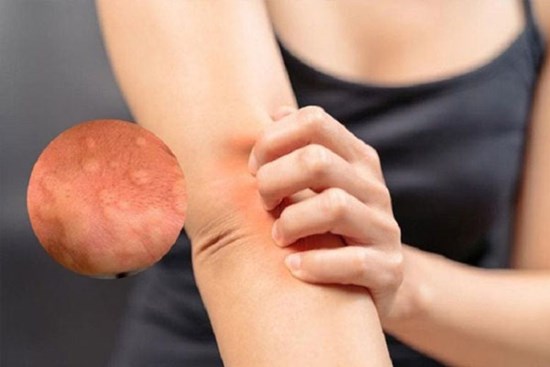 Sẩn ngứa khắp người, người phụ nữ 51 tuổi ở Phú Thọ đi khám bất ngờ dương tính với giun đũa chó mèo