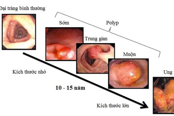 Người đàn ông ở Phú Thọ phát hiện mắc ung thư trực tràng từ một dấu hiệu nhiều người Việt bỏ qua-1