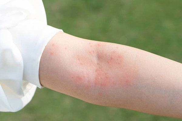 Cô gái sốc nặng khi thấy khuôn mặt biến dạng sau khi nhuộm tóc-2