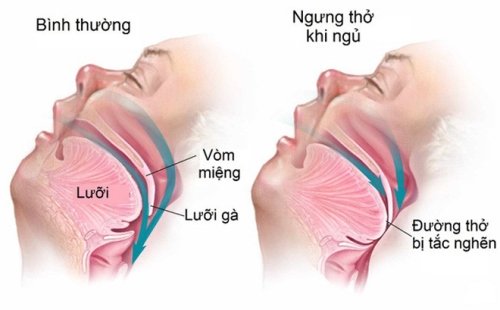 Hay buồn ngủ ban ngày, ngủ ngáy, mệt mỏi khi thức dậy, cần lưu ý hội chứng nguy hiểm này-1