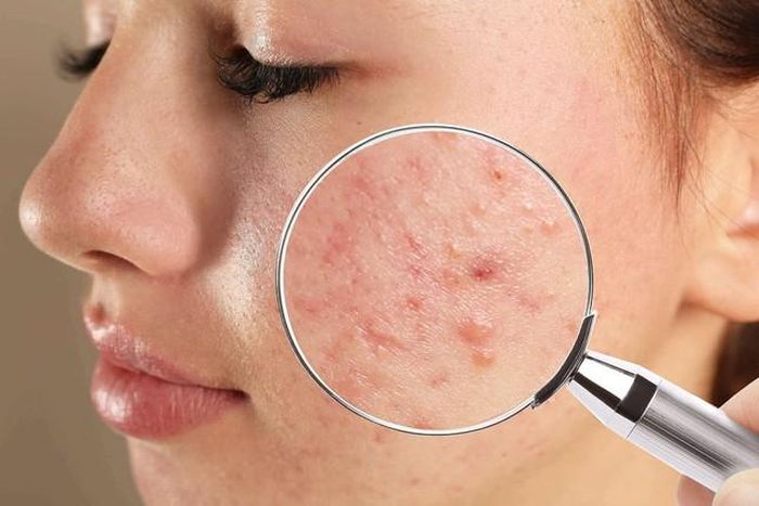Skincare chăm chỉ nhưng da vẫn nổi mụn, nguyên nhân là do dưỡng ẩm quá đà-1