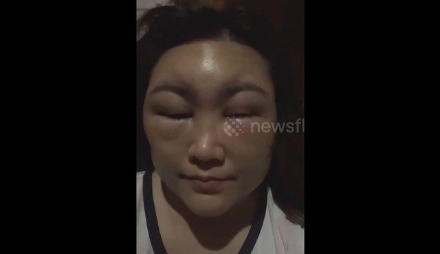 Cô gái sốc nặng khi thấy khuôn mặt biến dạng sau khi nhuộm tóc-1