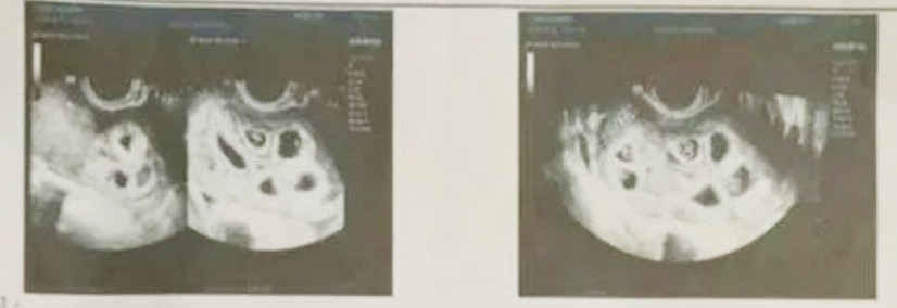 Người mẹ gây xôn xao khi mang 9 bào thai cùng một lúc-1