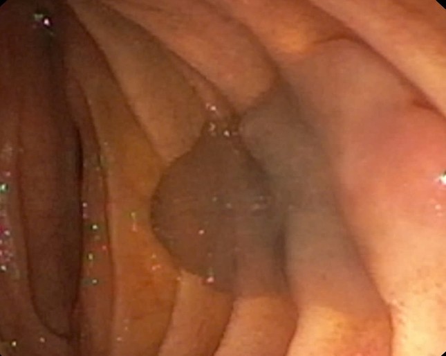 Phát hiện sán lá gan khủng trong ống mật cô gái trẻ-1