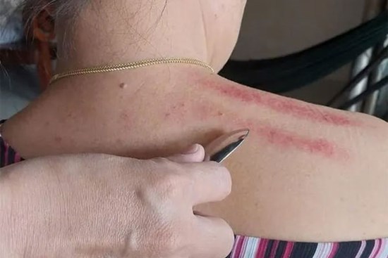 Cạo gió và những sai lầm cần tránh