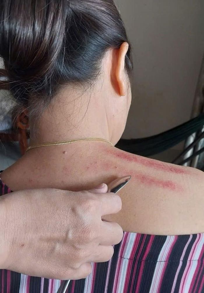 Cạo gió và những sai lầm cần tránh-1