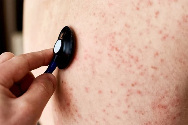 Số ca mắc sởi gia tăng tại Hà Nội-2