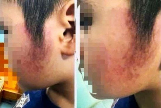 Kỷ luật cô giáo đánh bầm má học sinh ở Đắk Lắk