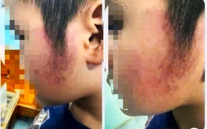 Kỷ luật cô giáo đánh bầm má học sinh ở Đắk Lắk-1