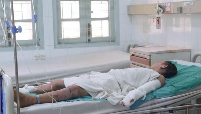 Liên tiếp 3 trẻ nhập viện do tự chế pháo nổ-1