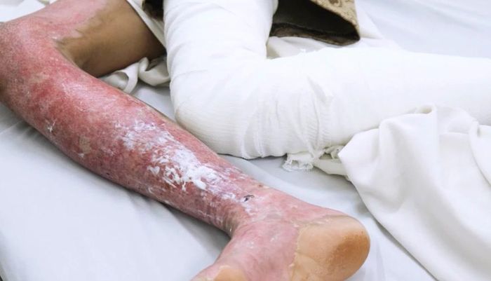 Liên tiếp 3 trẻ nhập viện do tự chế pháo nổ-2