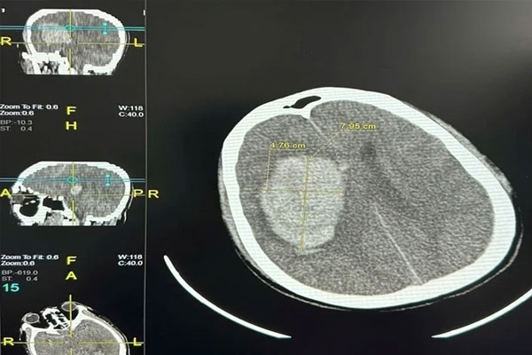 Những điều nên và không nên làm khi có người bị đột quỵ-2