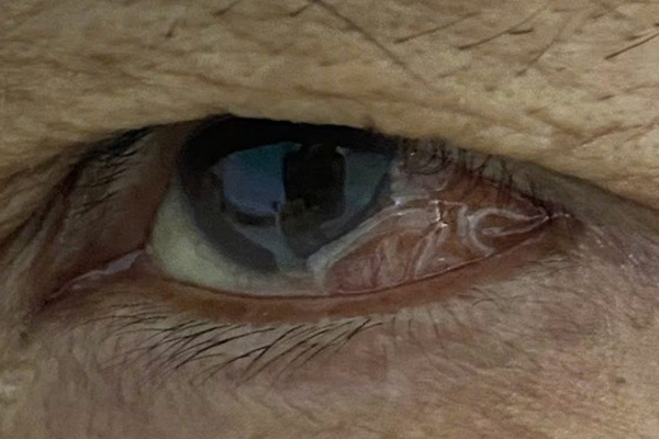 Cụ ông 77 tuổi bị giun bám kín ruột vì chủ quan với món ăn quen thuộc của nhiều gia đình Việt-3