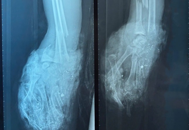 Chơi pháo tự chế, thiếu niên dập nát mất luôn bàn tay-1