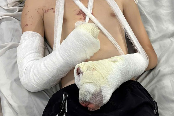 Bé trai 12 tuổi rách giác mặt, cắt cụt tay vì tự chế pháo-1