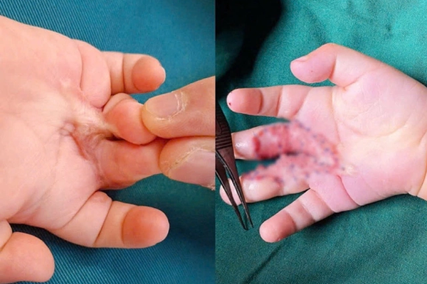 Bác sĩ cảnh báo: Gia tăng trẻ bị tai nạn thời điểm cận Tết-2