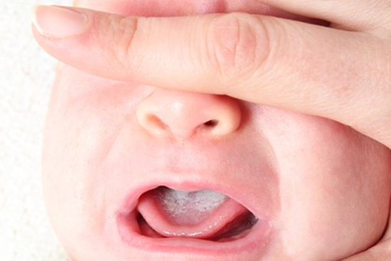 Cách xử trí khi trẻ bị bệnh nấm miệng