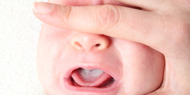 Cách xử trí khi trẻ bị bệnh nấm miệng-1