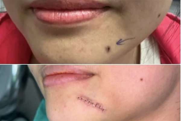 Phát hiện ung thư giai đoạn cuối từ dấu hiệu hay quên-2