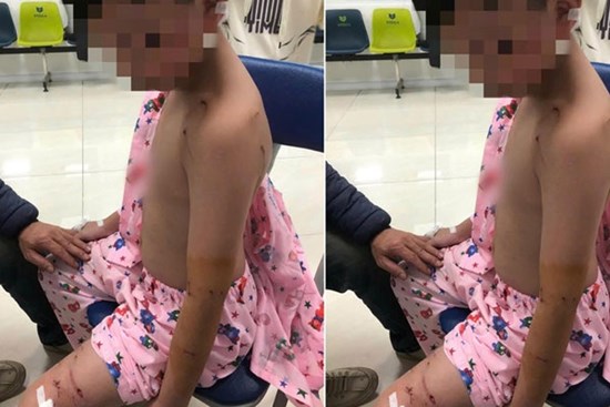 Bé trai 10 tuổi bị chó tấn công, trên người có nhiều vết thương