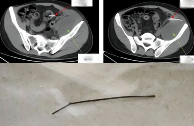 Chàng trai 28 tuổi đau bụng 3 tháng không đi lại được, đi khám bác sĩ lôi ra thứ dài 13cm từ trong bụng-1