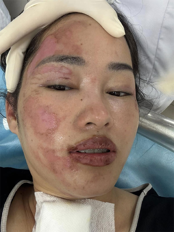 Sinh nhật kinh hoàng của cô gái Hà Nội: Bóng bay phát nổ, lửa trùm kín mặt-2