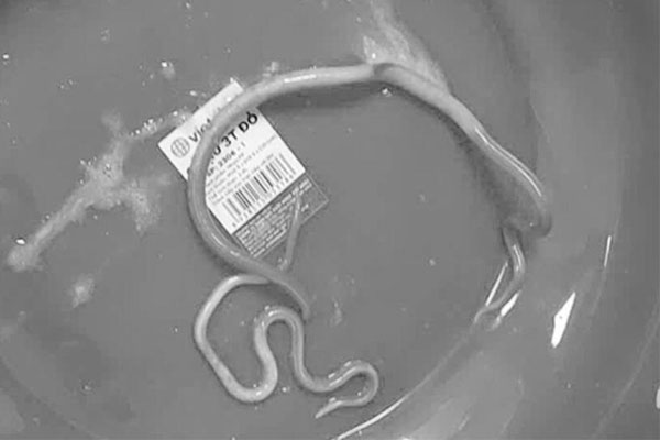 Cụ ông 77 tuổi bị giun bám kín ruột vì chủ quan với món ăn quen thuộc của nhiều gia đình Việt-1