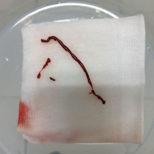 Liên tiếp điều trị cho 2 bệnh nhân đột quỵ, bác sĩ nói cả hai đều mắc chung sai lầm, phá nát mạch máu-2